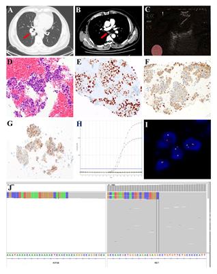 Neoadjuvant chemoimmunotherapy achieved a pathologic complete response in stage IIIA lung adenocarcinoma harboring RET fusion: a case report